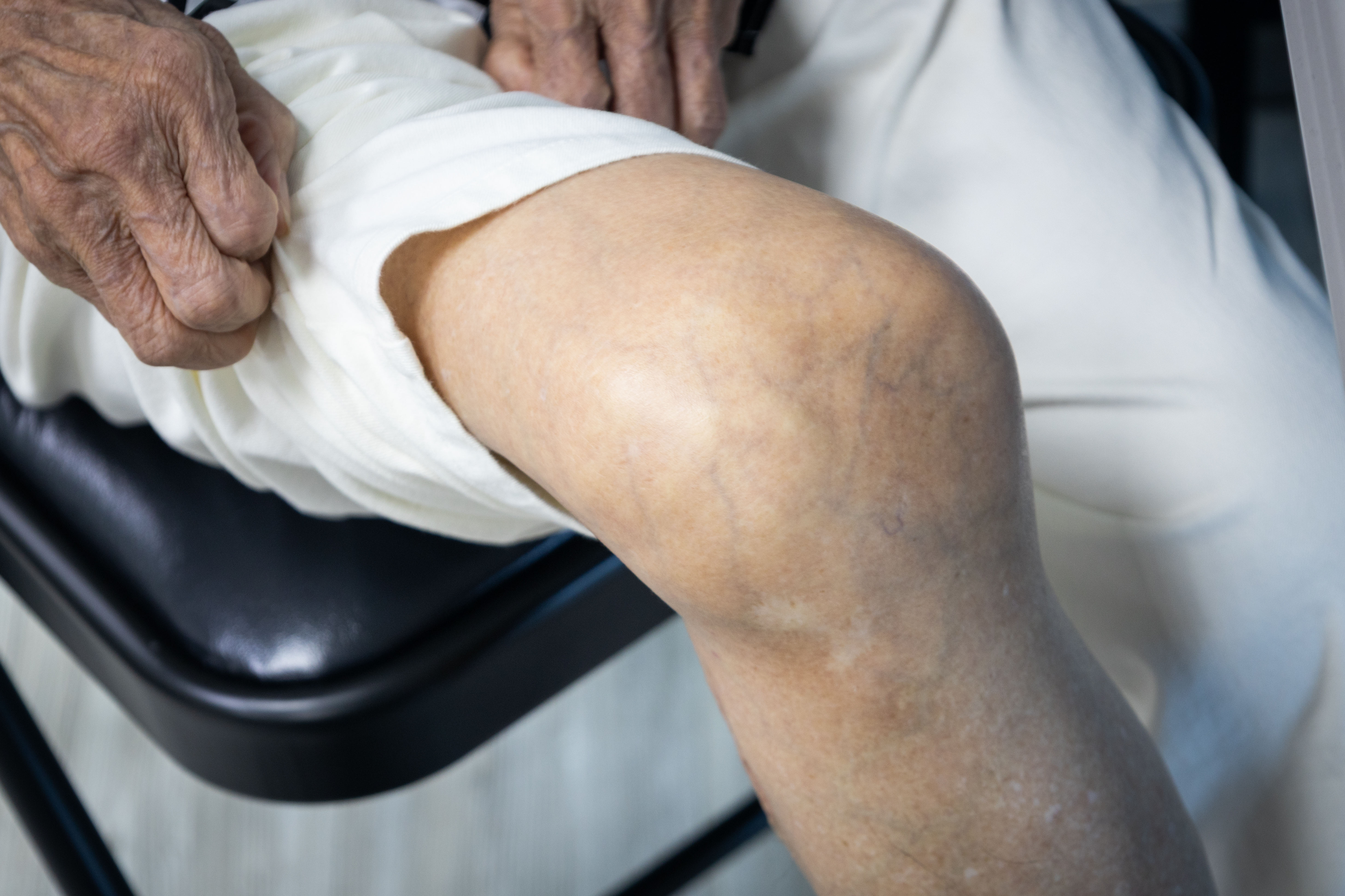 右腳韌帶的傷,讓潘秀雲的膝蓋已經變形,因此她改用墊腳尖的方式衝刺終點。(攝影/蔡昕翰)